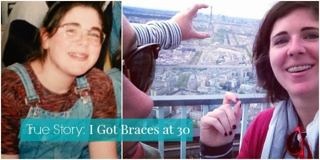 True Story: I Got Braces at 30